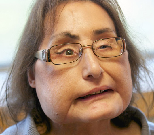 Las 10 noticias de salud más impactantes de 2010 - 2-Connie Culp ya tiene un nuevo rostro